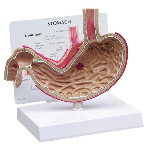 011Stomach Model with Ulcers