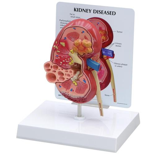 DIGESTIVE SYSTEM MODELS, Diseased Kidney Model