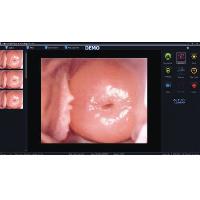 Colposcopy SOFTWARE for 29624. 29625